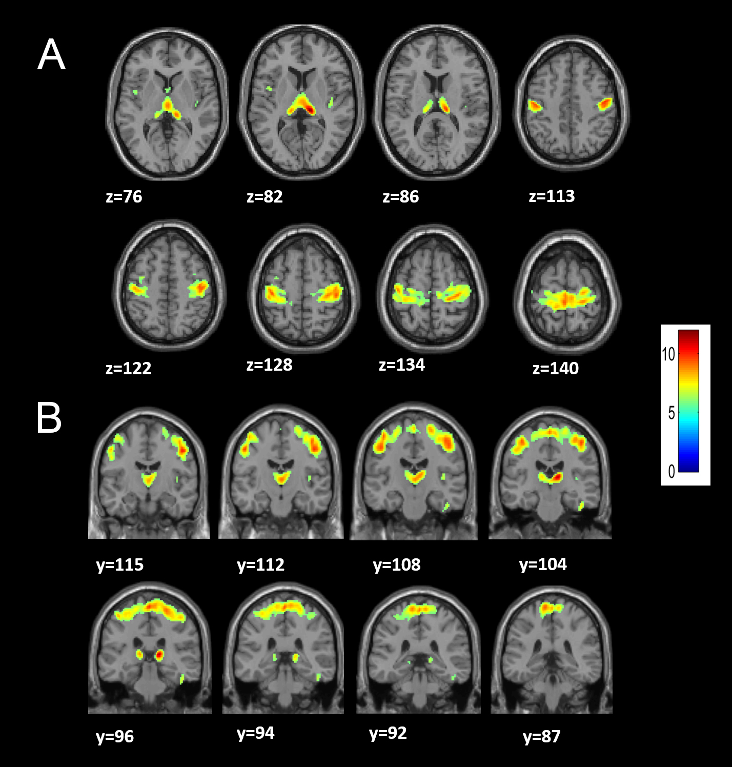 Escala de color azul rojo las áreas donde se produce atrofia cerebral en pacientes con hernias cervicales
