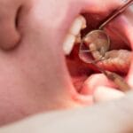 Caries dental: causas, síntomas, tratamiento y prevención
