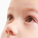 Conjuntivitis en niños: cómo detectarla, tratarla y prevenir contagios