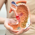 Manga gástrica: qué es, en qué consiste y para quién está indicada