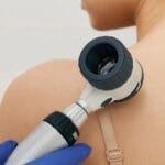 ¿Sabrías detectar un melanoma?